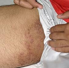 Scabies lesions on the skin may look like pimples, and the skin may also be red. Home Treatment For Tinea Cruris Or Jock Itch Ayurveda