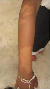 Pityriasis alba is a skin condition that commonly happens to children and to young adults, but any person can acquire it as well. Assessing Skin Disease And Associated Health Related Quality Of Life In A Rural Lao Community Bmc Dermatology Full Text