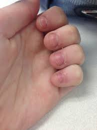 Keep the nails short to reduce the chances of any rips or tears as they grow out. How To Fix And Grow Out Bitten Nails B C Guides