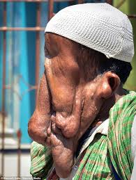1 in 1986, geneticists tibbles and cohen 2 demonstrated that merrick was actually afflicted with proteus syndrome, a much rarer condition. India S Elephant Man Turns Down Offer Of A New Face Because He Needs To Pay For His Daughter S Wedding Daily Mail Online