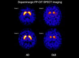 Visual hallucinations, or seeing things . Neuroimaging Characteristics Of Dementia With Lewy Bodies Alzheimer S Research Therapy Full Text