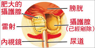 攝護腺雷射剜除手術助85歲翁擺脫尿管- 健康醫療- 自由電子報