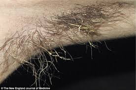 Armpit lumps are very common and are normally caused by a swollen lymph node or gland under the armpit. The Stench That No Deodorant Can Mask Man 40 Suffered From Extreme B O For Four Years Because His Armpits Were Infected Daily Mail Online