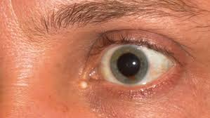 Image result for milium cyst on eyelid