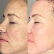 Candela Medical UK & Ireland