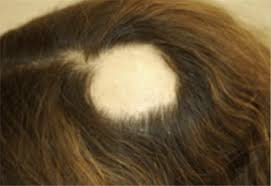 Hair Loss Who Gets And Causes