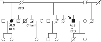 Pedigree Of The Reported Kfs And Als Family Als Amyo Open I