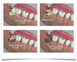 Walter lupi — fragile 2000 (sting) 04:17. Visdomstaender Behandling Af Visdomstaender Hos Tandnu Dk