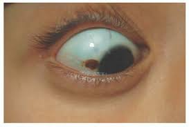 Image result for melanosis sclera