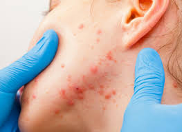 We did not find results for: Nose Acne Causes Treatment And Remedies