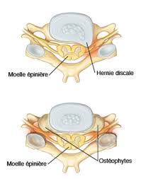 On la rencontre principalement chez l'adulte. Nevralgie Cervico Brachiale Chirurgie De La Colonne Vertebrale Beziers