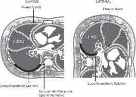 Image result for Intrapleural Anesthesia