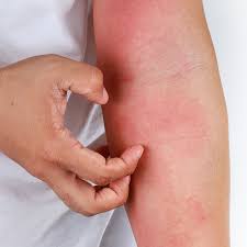 Image result for Skin Infection