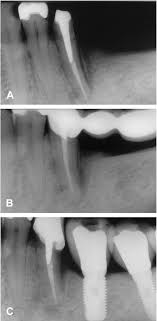 Methods treatment outcome for the teeth with a cemental tear was assessed in a multicenter cemental tear study project. Https Www Scielo Br J Roc A Hqcqprgmtjbqc9vsnpdzbvx Lang En Format Pdf