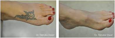 Up to 71% off tattoo removal at ink on ink off. Laser Tattoo Removal Cleveland Westlake Amazing Results Dr Diwan