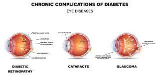 Maybe you would like to learn more about one of these? Diabetic Eye Problems Symptoms Treatment And Prevention Irisvision