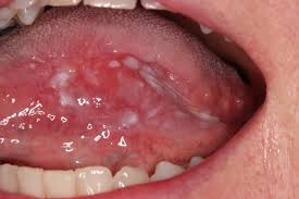 Image result for Erythroplakia roof of mouth
