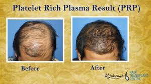Some studies have suggested that prp can accelerate growth after hair transplant surgery. Prp Treatment Results Before And After Prp Therapy For Hair Loss Indore Youtube