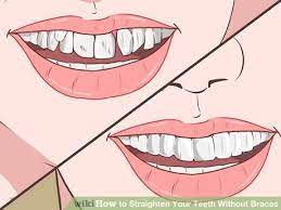 How To Straighten Your Teeth Without Braces Fix Teeth Straight Teeth Without Braces Teeth Braces