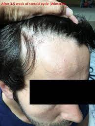 Winstrol is perhaps the very worst steroid for hair loss. Short Anabolic Cycle Bye Bye Hairline Hello Balding Baldtruthtalk Com