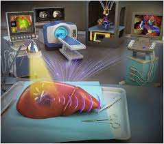 About open liver resection surgeons make an incision across the right upper abdomen, below the ribcage, to remove the tumor. Digital And Intelligent Liver Surgery In The New Era Prospects And Dilemmas Ebiomedicine