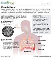 02.04.2020 · standard treatments for mesothelioma include surgery, chemotherapy and radiation therapy. Pin On Treatment For Mesothelioma Lung Cancer