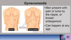 Gynecomastia is not breast cancer, neither does it increase the chance of breast cancer in the future. Jordana Phillips On Twitter 7 Common Non Cancerous Entities That Form In Men Are Gynecomastia Angiolipoma Schwannoma Papilloma Lipoma Fat Necrosis And Sebaceous Cysts Gynecomastia Is Pretty Common Men May Present To Their Doctor