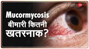 Indolent mucormycosis of the paranasal sinus in immunocompetent patients: à¤œ à¤¨ à¤ à¤• à¤¯ à¤¹ Mucormycosis à¤¬ à¤® à¤° à¤œ à¤¸à¤¸ à¤† à¤– à¤• à¤° à¤¶à¤¨ à¤šà¤² à¤œ à¤¤ à¤¹ Coronavirus Black Fungus Youtube