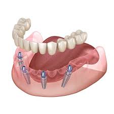 Maybe you would like to learn more about one of these? All On Four Dental Implants Houston Tx Missing Teeth Dentures