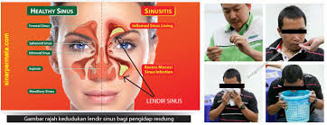 Bau antibiotik apa tidak, yaitu dengan cara bila mulutnya tercium seperti bau antibiotik tandanya gadis / wanita tersebut. Kenali Tanda Tanda Resdung Sinarpermatacheras