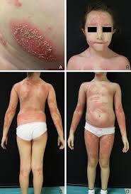Image result for Pustular Psoriasis