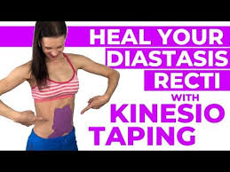 Diastasis Recti Kinesio Taping Youtube In 2020 Diastasis Recti Diastasis Recti Exercises Kinesio Taping