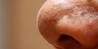 Maybe you would like to learn more about one of these? Whiteheads On Nose Causes Treatment And Prevention