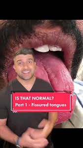 Image result for Fissured tongue