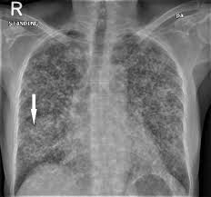 This manual would not have been possible without the comments and suggestions of colleagues with considerable. Cureus Metastatic Adenocarcinoma Of The Lung Mimicking Miliary Tuberculosis And Pott S Disease