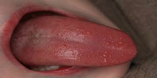 We did not find results for: Lingua A Fragola Tutte Le Possibili Cause Roba Da Donne