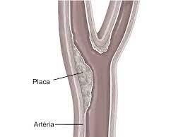 Os estudos sugerem que 10 a 20% dos avc isquêmicos podem ser causados por aterosclerose carotídea, prevalência que parece ser maior em pacientes com diabetes . Esteneose Carotidea Neocure