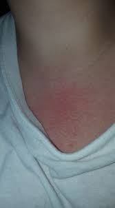 32 Photos That Reveal The Different Ways Fibromyalgia Can Present Itself Fibromyalgia Fibromyalgia Symptoms Fibromyalgia Rash