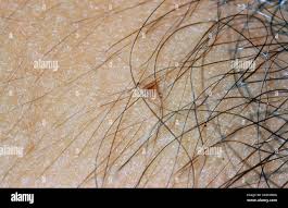 Image result for pubic lice symptoms
