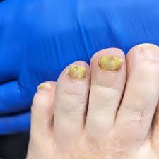 Image result for Yellow nail syndrome feet