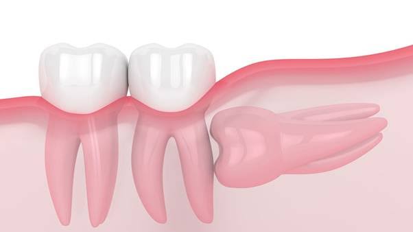 bảng giá nhổ răng khôn mọc lệch