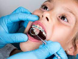 Check spelling or type a new query. Clearing Up The Confusion About Spacers Reddick Orthodontics