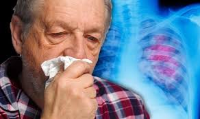 Many people with lung cancer don't have symptoms until the disease is in its later stages. Lung Cancer Symptoms Signs Of A Tumour Include Blood In Mucus Express Co Uk