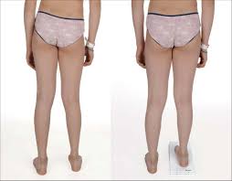 Image result for Functional Leg Length Discrepancy