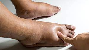 Kaki bengkak adalah kondisi medis ketika terjadi penumpukan cairan pada kaki. 8 Penyebab Kaki Bengkak Yang Wajib Anda Tahu