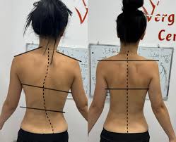 كيف يؤثر العمر على دقة تشخيص اعوجاج العمود الفقري؟