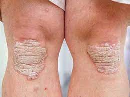 Selecione entre imagens premium de psoriase da mais elevada qualidade. Psoriase O Que E Tipos Causas Sintomas Tratamento