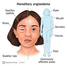 Image result for Angioedema