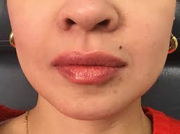 Achieve a fuller look with our safe & effective lip enhancements! Lip Fillers Before And After 18 Montilla Plastic Surgery
