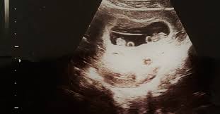 Caracteristica generala a sarcinii multiple ii. Sarcina Mea Cu Gemeni Identici Vestea Mama La Patrat